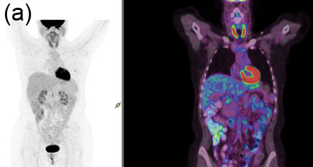 Applications et interprétation du PET-CT au FDG chez les patients sous immunothérapie