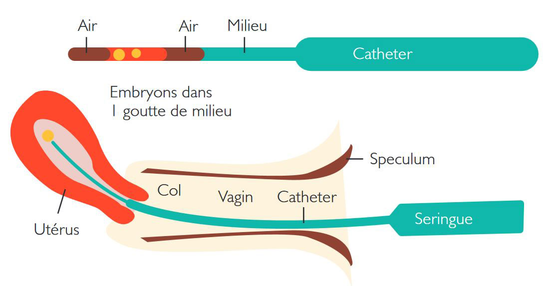 FIV > étape 6: le transfert embryonnaire - Groupe santé CHC